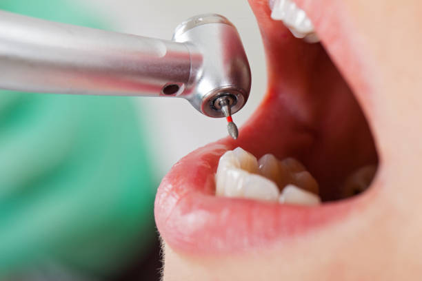 Best Emergency Treatment for Dental Infections or Abscesses in Bellevue, PA
